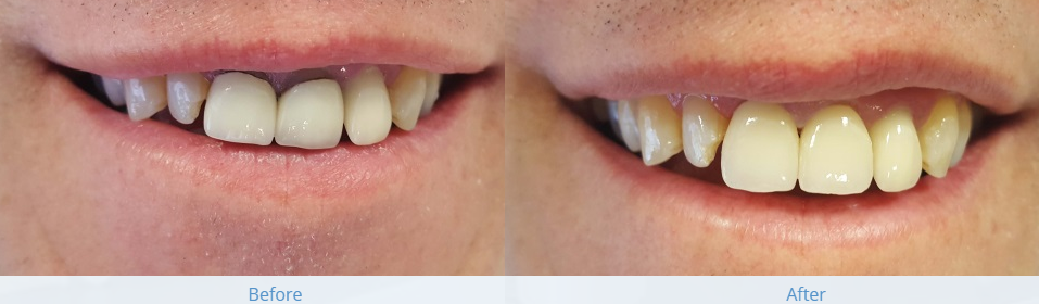 Crown treatment before and after